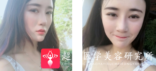面部提升术