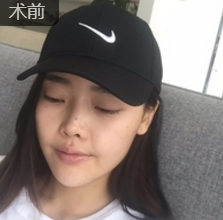 面部提升术