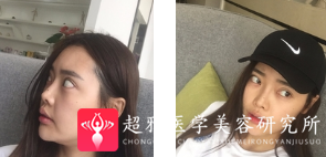 面部提升术