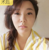 面部提升术