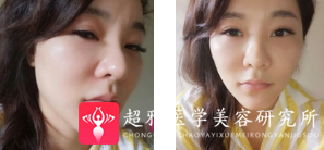 面部提升术