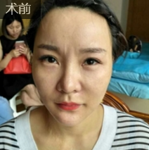 面部提升术