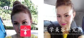 面部提升术