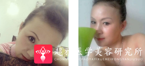 面部提升术