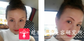 面部提升术