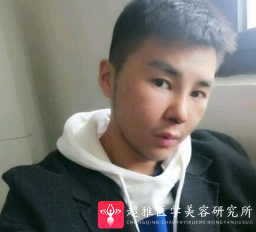隆鼻手术