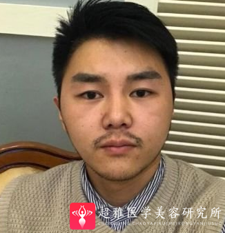 隆鼻手术