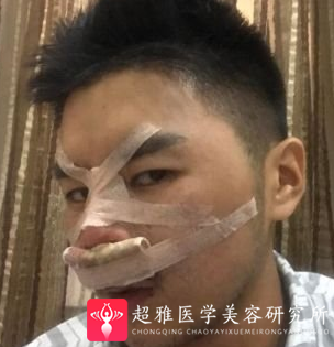 隆鼻手术