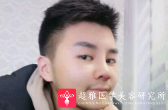 隆鼻手术