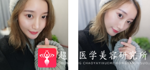 面部提升术