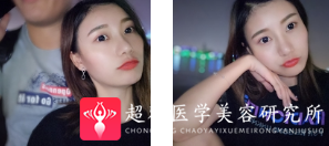 面部提升术