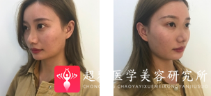 面部提升术