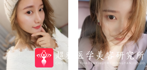 面部提升术