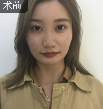 面部提升术