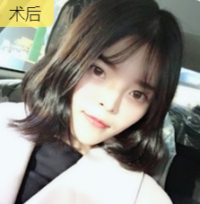 面部提升术