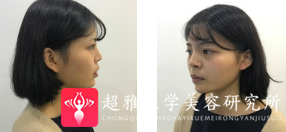 面部提升术