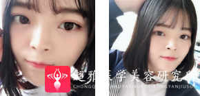 面部提升术