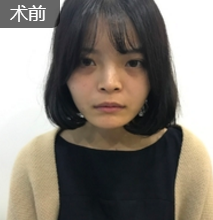 面部提升术