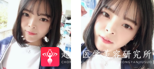 面部提升术