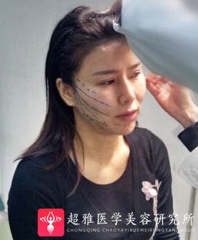 面部提升术