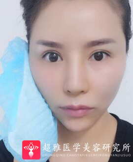 面部提升术