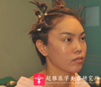 面部提升术