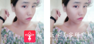 自体脂肪填充术