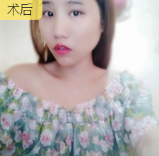 自体脂肪填充术