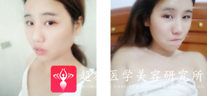 自体脂肪填充术