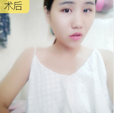自体脂肪填充术