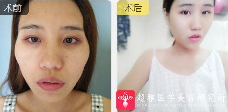自体脂肪填充术