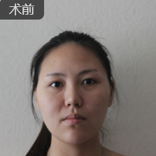 面部提升术
