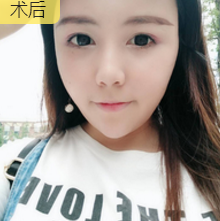 面部提升术