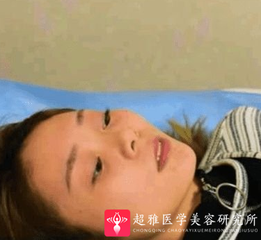 自体脂肪填充术