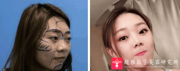 自体脂肪填充术