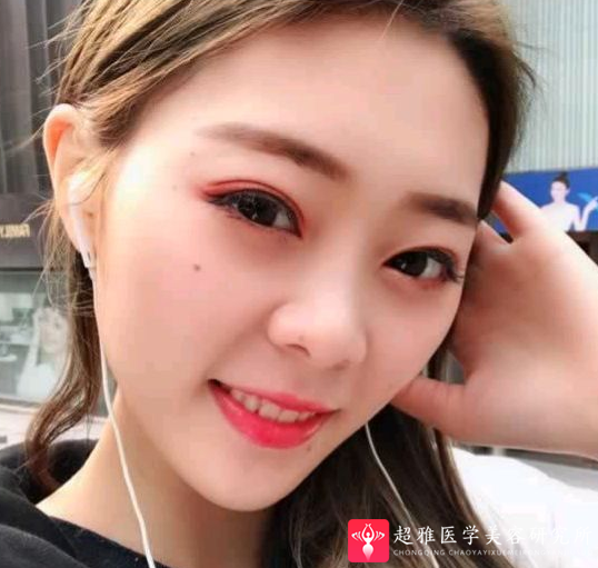 自体脂肪填充术