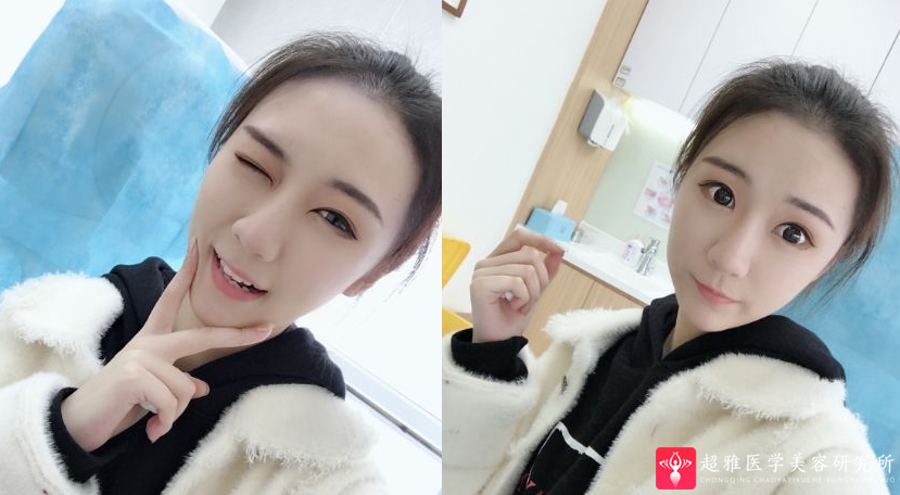 自体脂肪填充术