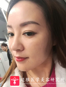 面部提升术