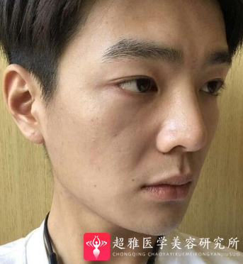 面部提升术