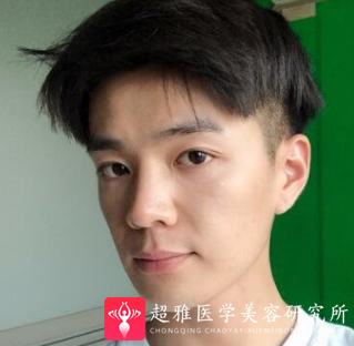 面部提升术