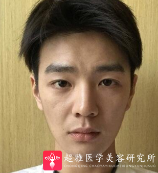 面部提升术