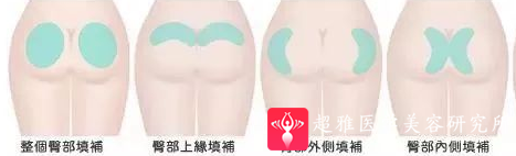 自体脂肪填充术