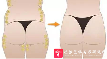 自体脂肪填充术