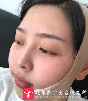 吸脂瘦脸