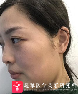 吸脂瘦脸