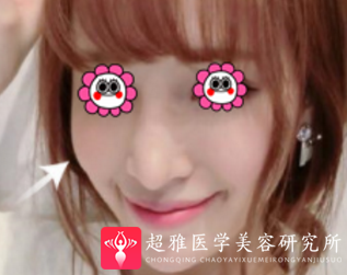 自体脂肪填充术