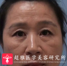 面部提升术
