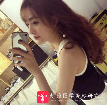 隆鼻手术