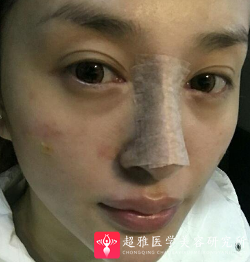隆鼻手术