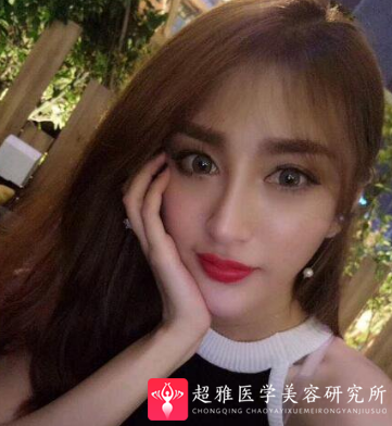 隆鼻手术